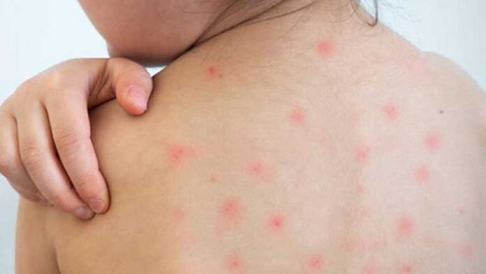 হামের লক্ষণ কী