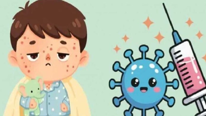 হাম উপসর্গে ৯৪ জনের মৃত্যু