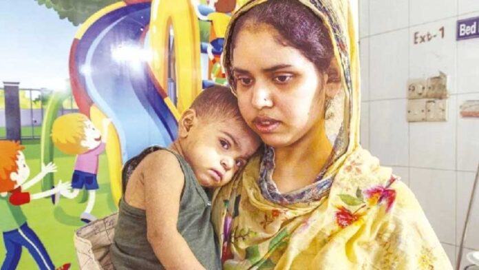 হামের উপসর্গ নিয়ে ২৯ দিনে ১৭৪ শিশুর মৃত্যু