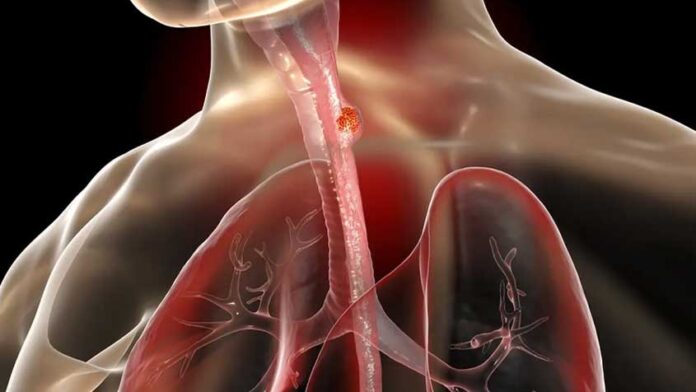 নীরবে শরীরে বাসা বেঁধেছে ক্যানসার, যেসব লক্ষণ অবহেলা করলেই বিপদ