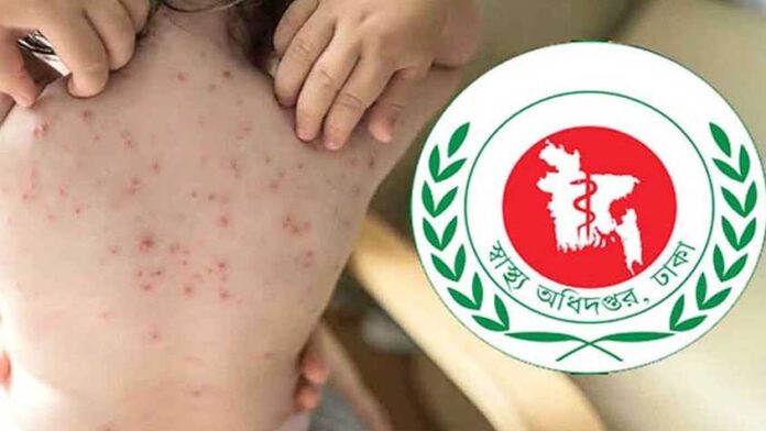 বাড়ছে চিকেন পক্সের প্রকোপও