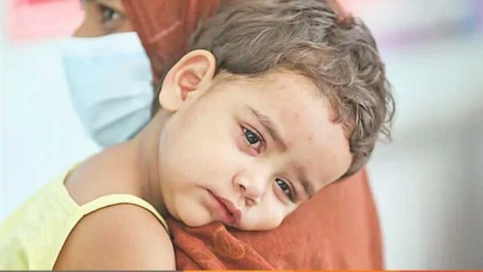 হাম ও হামের উপসর্গে আরও ১০ শিশুর মৃত্যু, শনাক্ত ১১৩৬